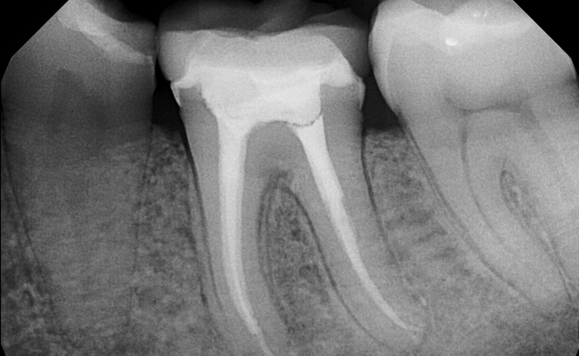 Root-Canal-Treatment